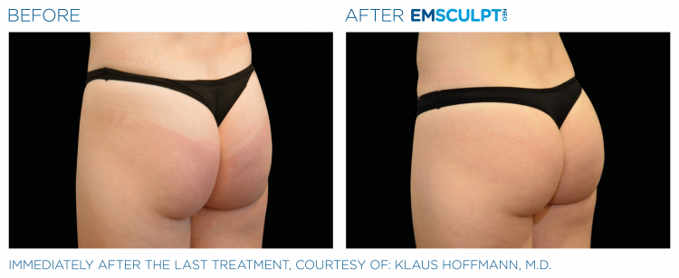 Buttocks Before & After | EMSCULPT NEO | Ortega Plastic Surgery