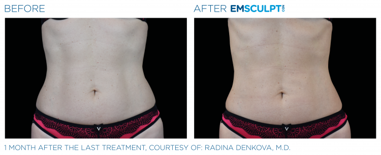 Abdomen Before & After | EMSCULPT NEO | Ortega Plastic Surgery