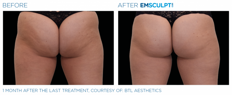Female Buttock Before & After | EMSCULPT NEO | Ortega Plastic Surgery