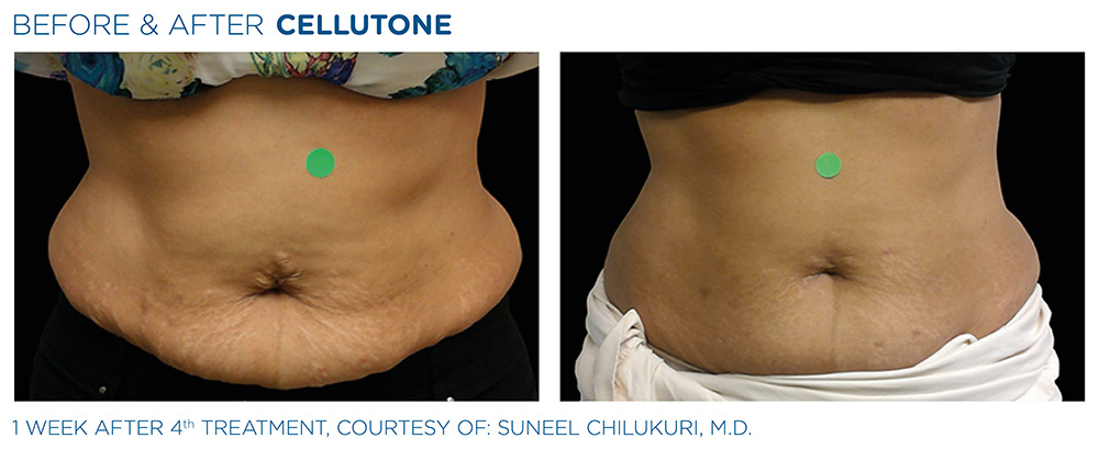 Female Abdomen Before & After | CELLUTONE | Ortega Plastic Surgery