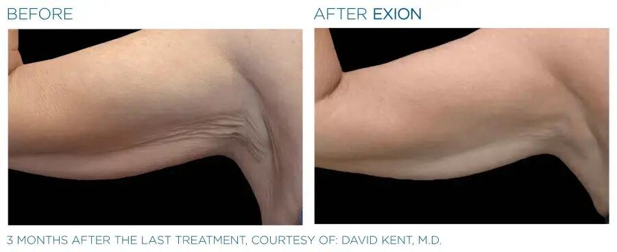 Exion-Body-Before-and-after-1-1