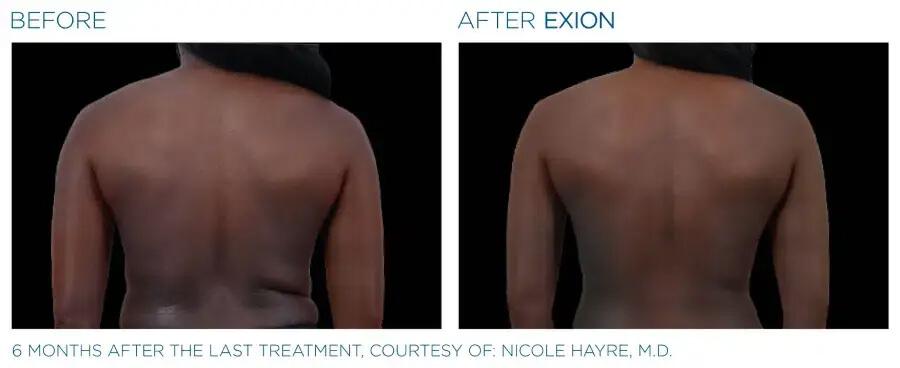 Exion-Body-Before-and-after-4-1