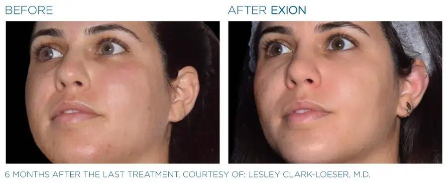 Exion-Face-Before-and-after-1-1