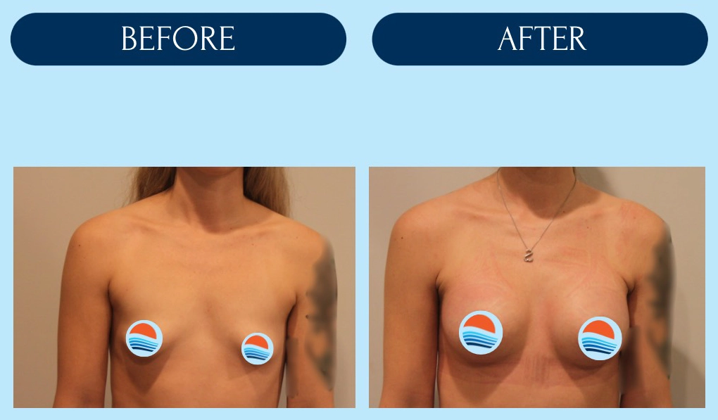 Breast Augmentation | Before & After | Ortega Plastic Surgery